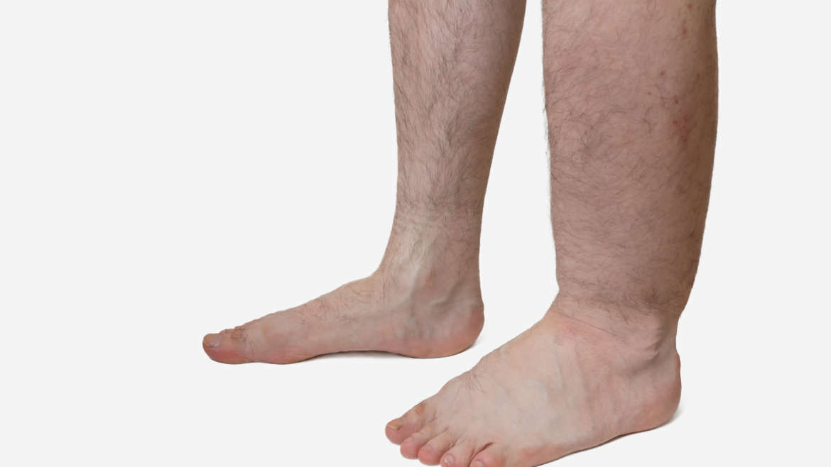 Edema (leg swelling)
