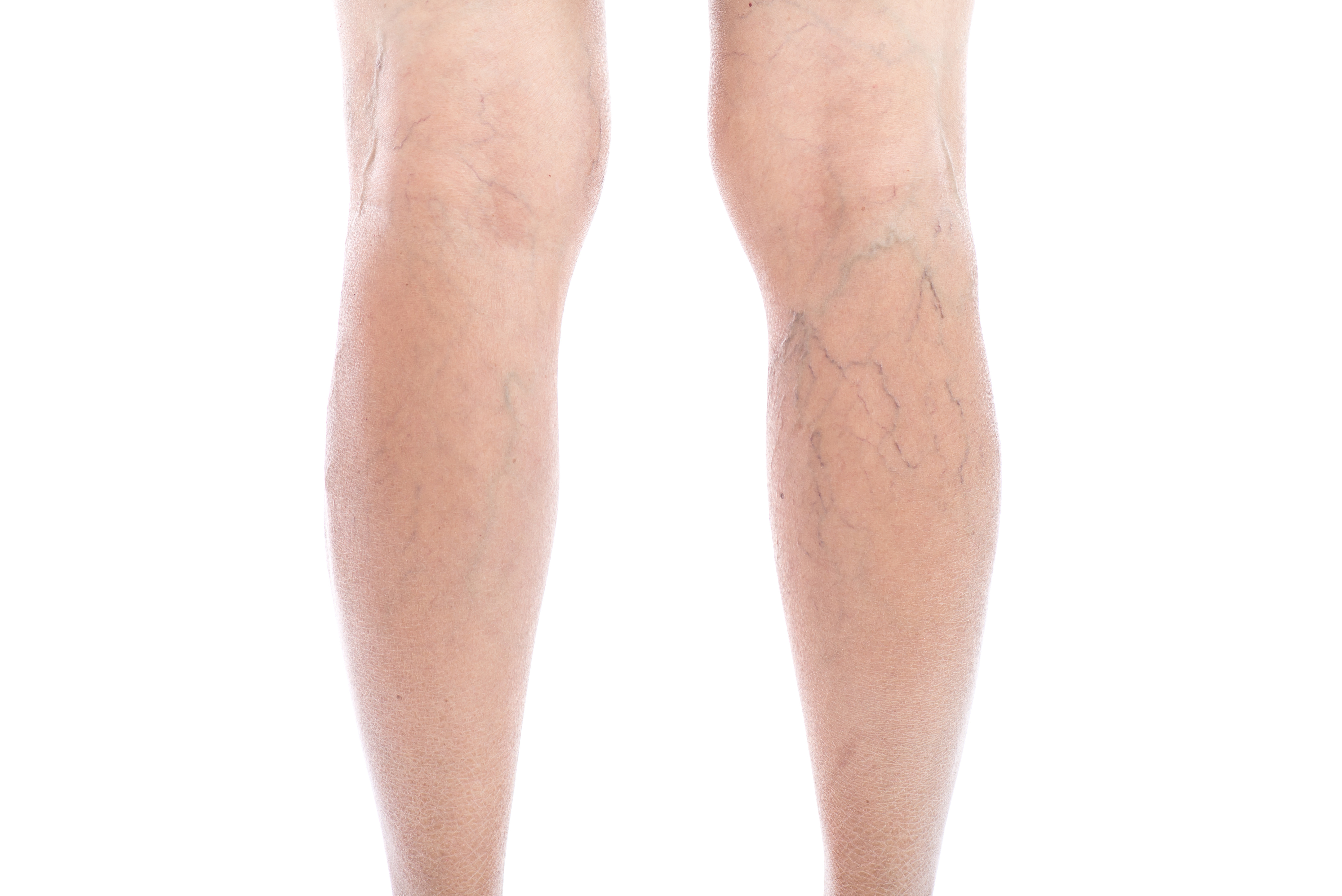 Spider Veins McQuaid Vein Care