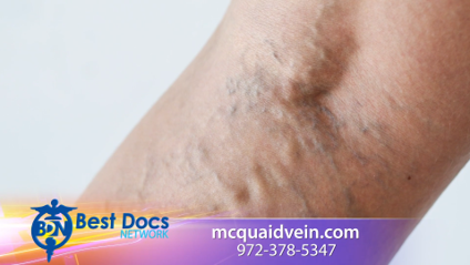 What Causes Spider and Varicose Veins?