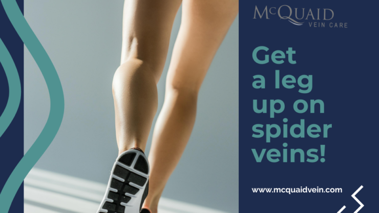 6 Health Tips for Reducing Spider Veins