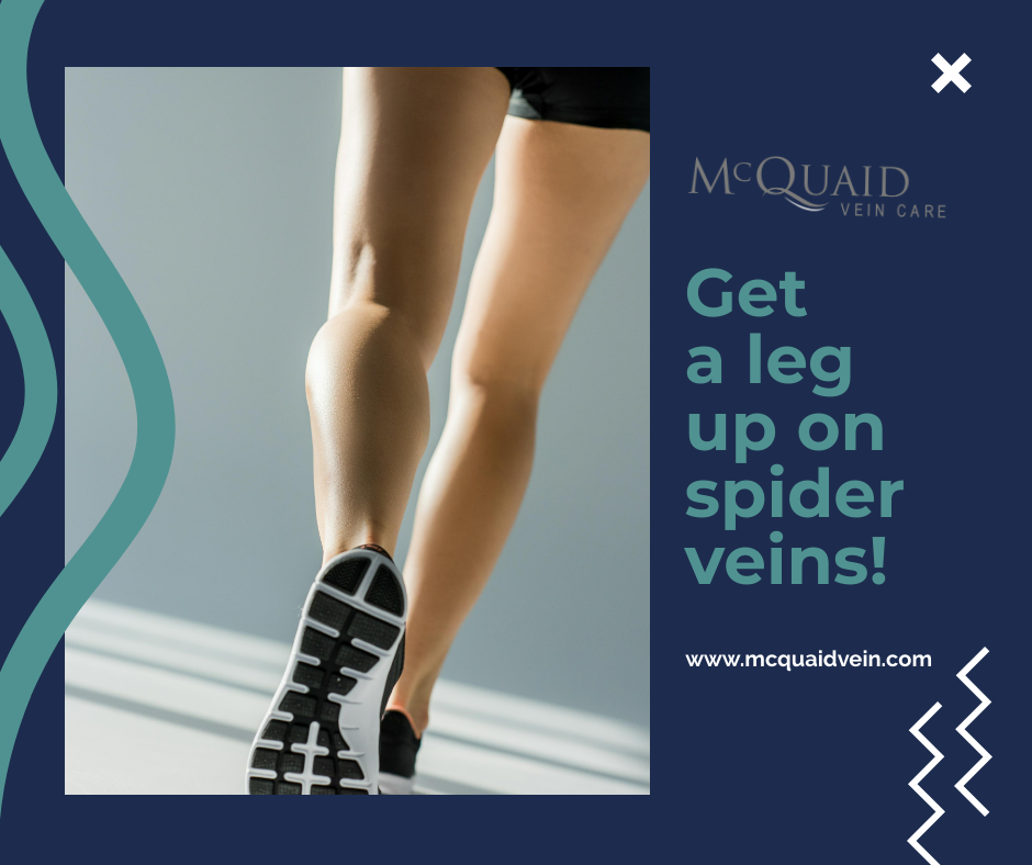 6 Health Tips for Reducing Spider Veins